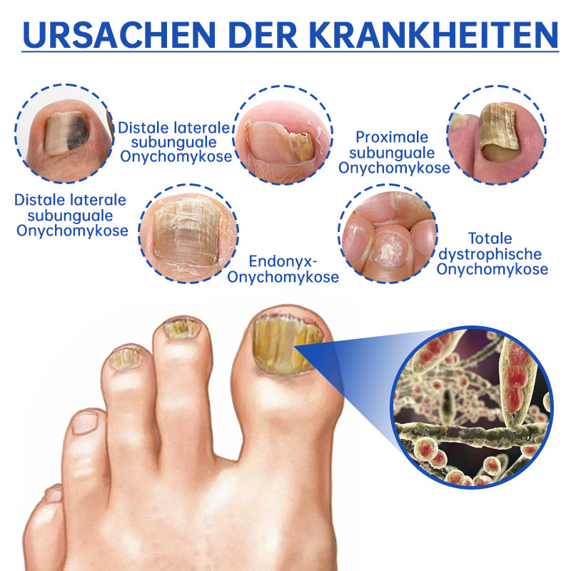 PureNail | Pilz-Lasertherapiegerät - Ihre Geheimwaffe gegen Nagelpilz