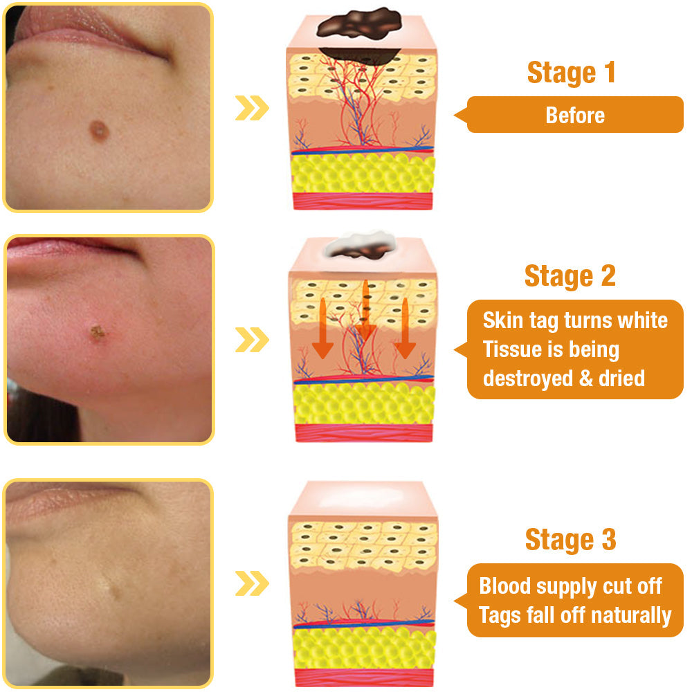 1+1 Free | TagAway™ - Effective removal of warts and skin growths