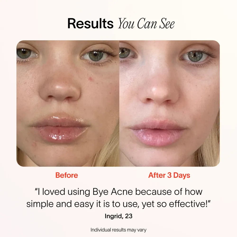 ByeAcne™ - You don't want to have acne this year! [Last day discount]