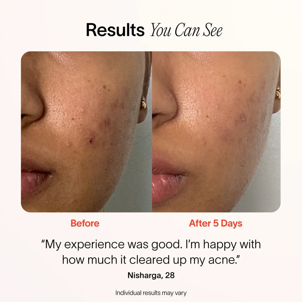 ByeAcne™ - You don't want to have acne this year! [Last day discount]