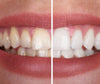 1+1 FREE | MYsmile™ - enjoy a bright white smile without risk!