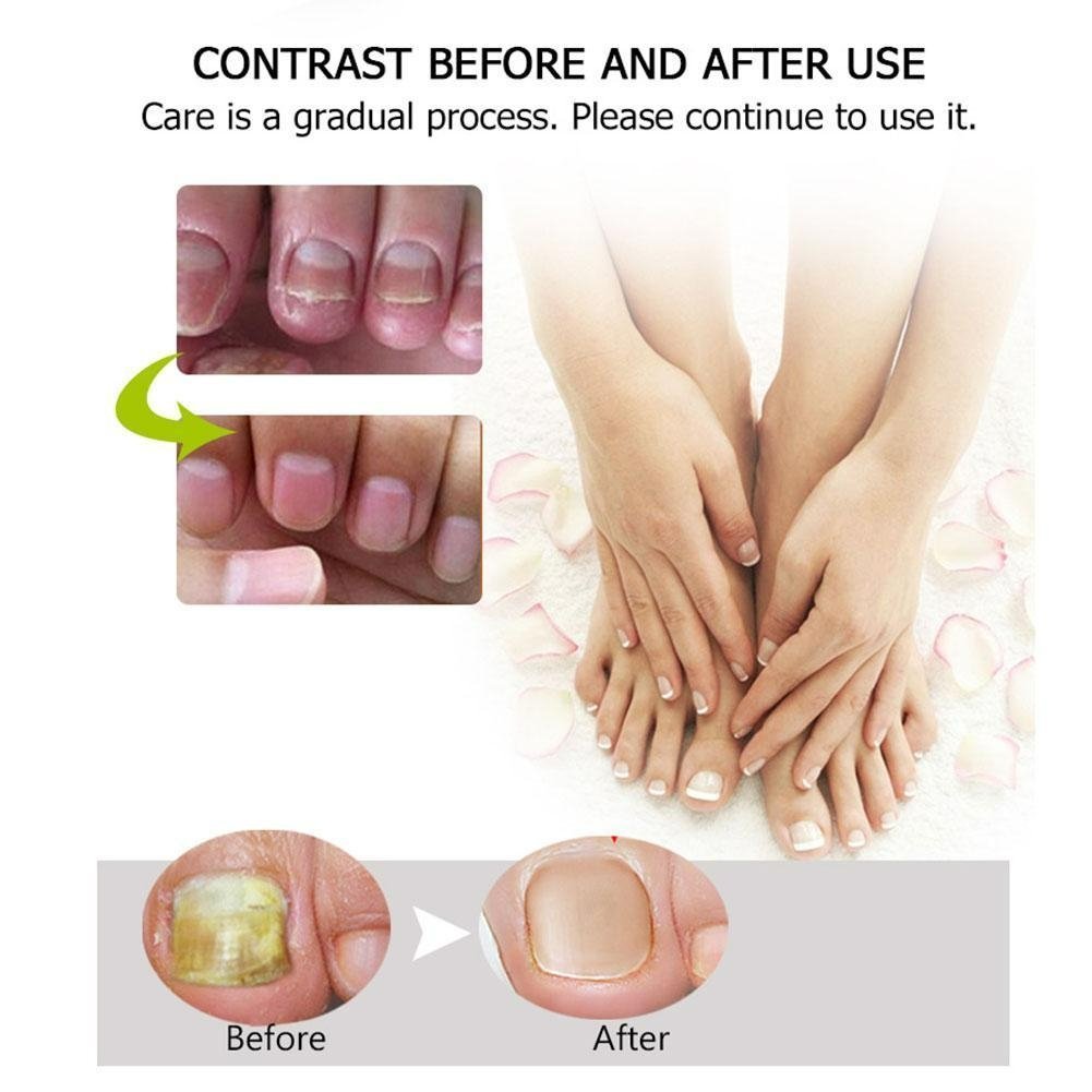 Nail Repair™ - Fast and effective results! [Last day discount]